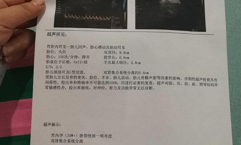 羊水指數(shù)新標(biāo)準(zhǔn)詳解，25cm指南解讀