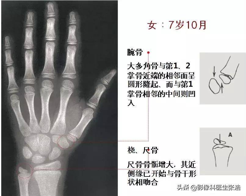 女孩骨齡對(duì)照表最新解讀及指南